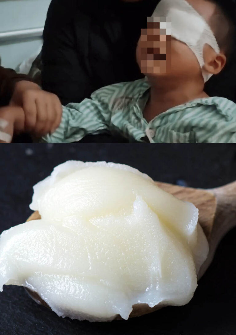 Boy Went Blind after Teacher Rubs Pig Lard on His Eye